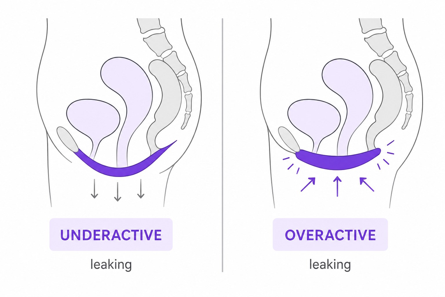 Illustration comparing an underactive pelvic floor and an overactive pelvic floor, both causing leaking